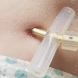 g tube stoma