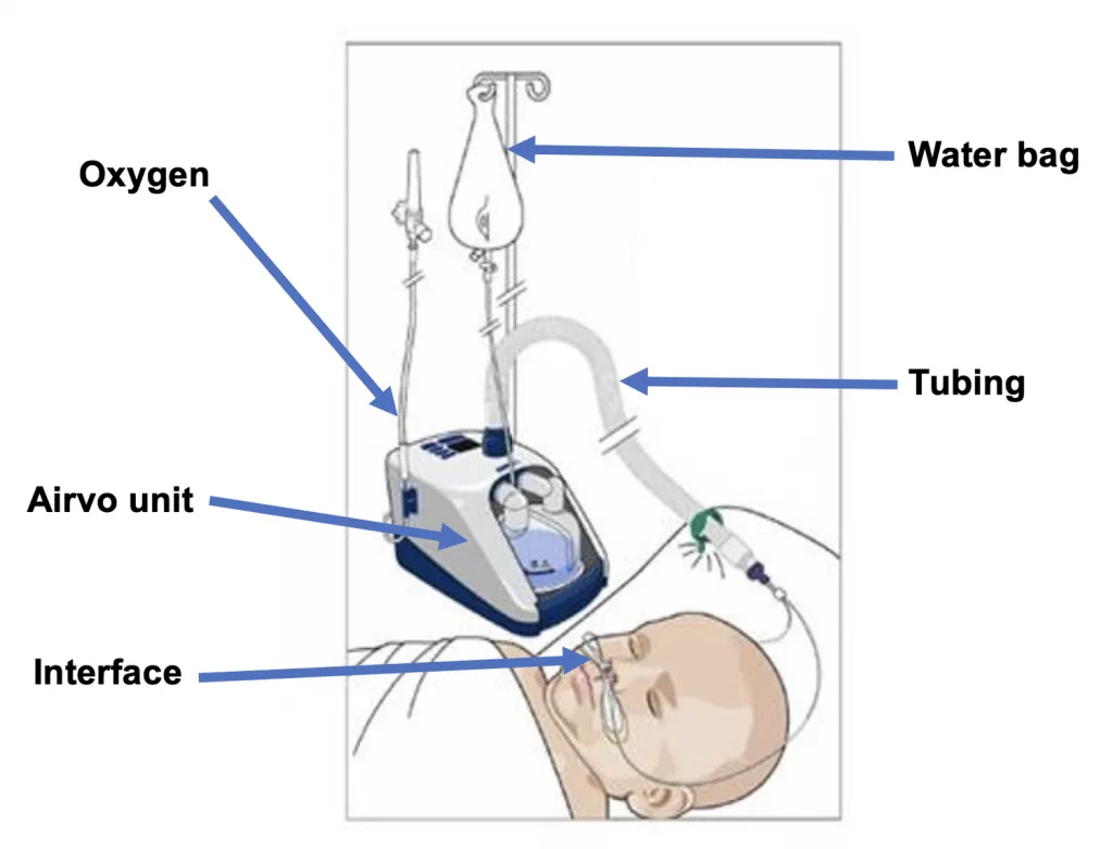 Child wearing heated high flow therapy via nasal cannula. This photo is from the F&P Airvo User Manual.