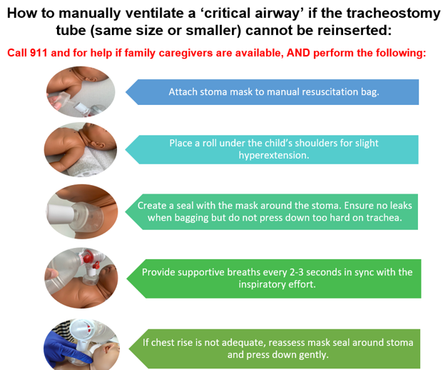 How to use a stoma mask for a child with a critical airway screenshot 2026 05 27 122408