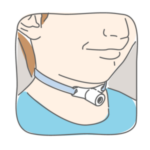 Tracheostomy 1 150x150