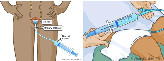 HINT: How to prevent infection during bladder irrigation and instillation? bladder1 2