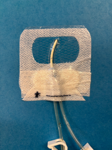 What is Clik-FIX® and how is it used to secure central venous access devices? primary CVAD dressing with the exit site visible through the transparent window and the Clik-FIX® covered