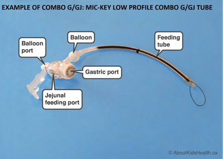 Do you know what type of enteral feeding tube the child has? comboggjmickey
