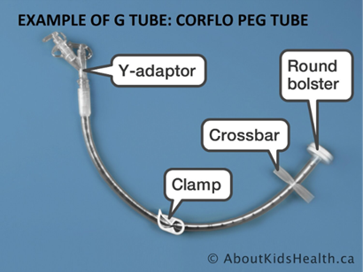 Do you know what type of enteral feeding tube the child has? corflopeg