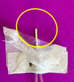 insertion site of CVAD exposed