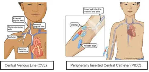 CVL and PICC on child