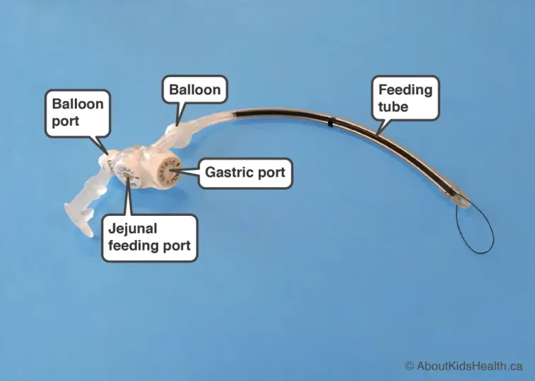 How do I vent a G-tube to manage fullness and bloating? Gtubes Mickey Lowprofile Combotube