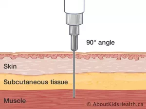 90 degree injection