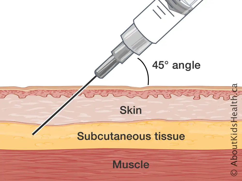 45 degree injection