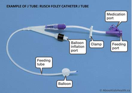 Do you know what type of enteral feeding tube the child has? jtube