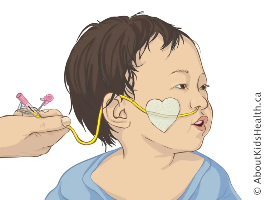 Why use a guidewire for nasogastric (NG) tube insertion? NG tube on a child illustration
